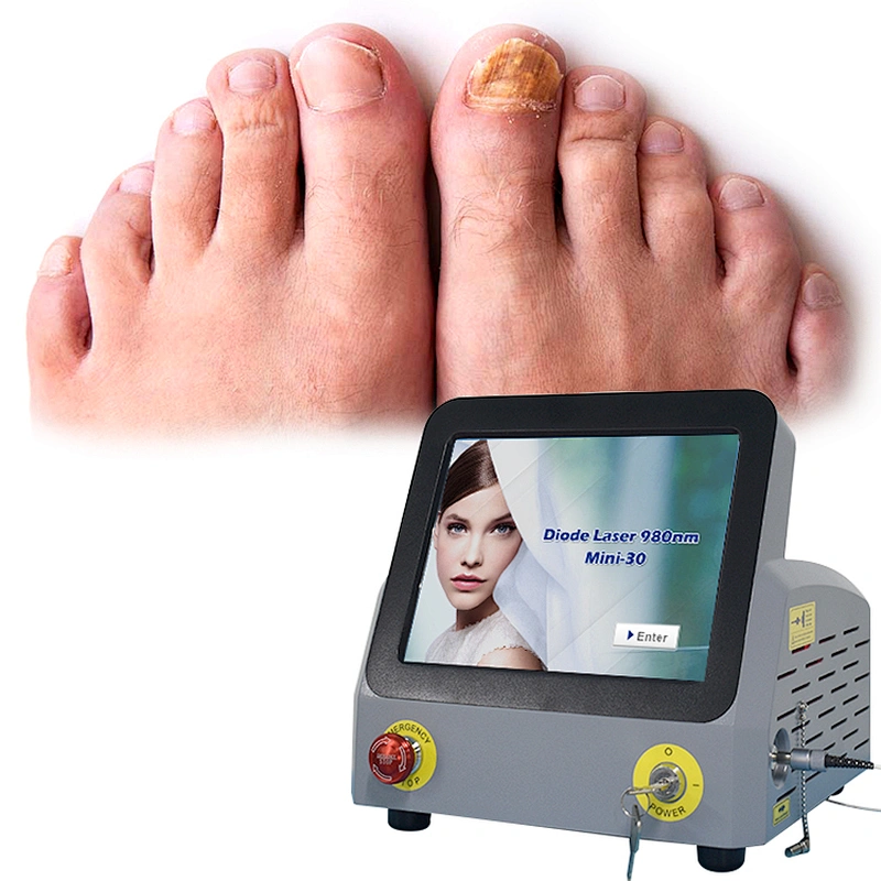 2024 Aesthetic Surgery 30w Podiatry Laser Treatment Machine 980nm Diode Laser Nail Fungus Treatment Device