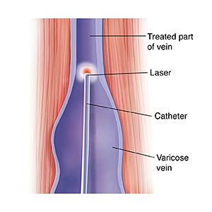 Intravenous Laser Ablation Laser EVLT EVLA  Leg Varicose Veins 1470nm  Laser Machine