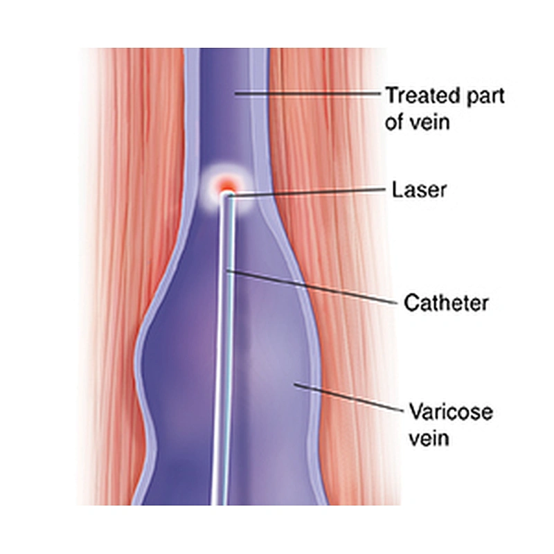 Intravenous Laser Ablation Laser EVLT EVLA  Leg Varicose Veins 1470nm  Laser Machine