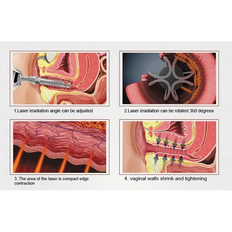 Surgical Gynecological  Minimal Invasive Device Gynecology Laser Vaginal Tightening Machine