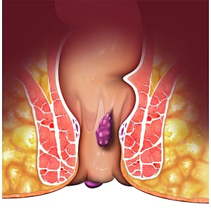 Dual Wave 980nm 1470nm Diode Laser Treatment Hemorrhoid and Hemorrhoid Cutting