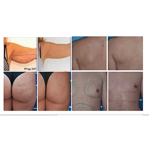 Triangel 980nm 1470nm 47w Laser Lipolysis  Face Lift Skin Retraction Machine