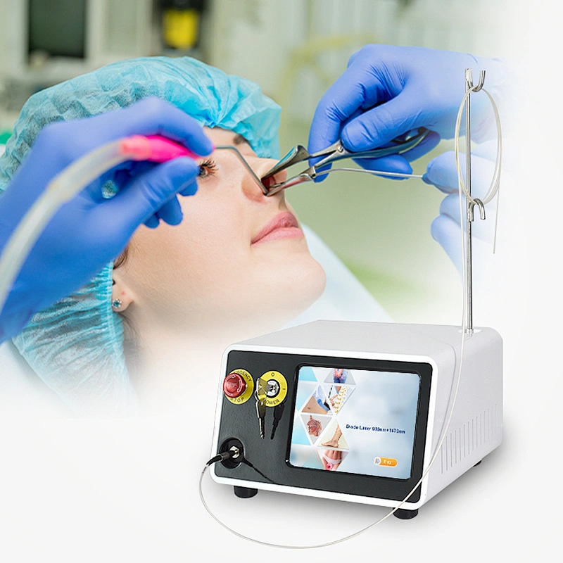 980nm or 1470 nm High Power Medical Diode Laser in ENT Treatment
