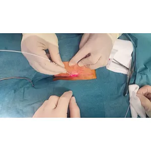 Proctology Laser Surgery 1470 Nm Proctology Diode Laser Hemorroide Fistula Machine