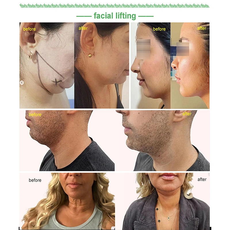Best Price Italian Laser 1470nm Endoskin Lifting Tightening Rejuvenation Body Contouring Fat Reduction Diode Laser