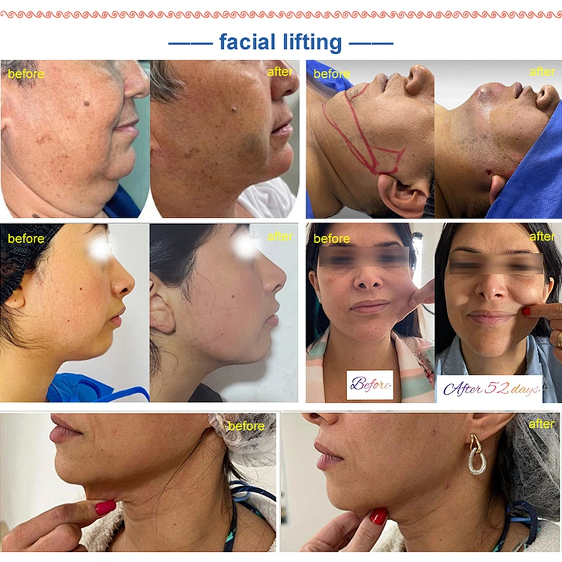 2024 Beauty Laser 980nm+1470nm Wavelengths Liposuction Lipolysis Lift Laser Beauty Equipment