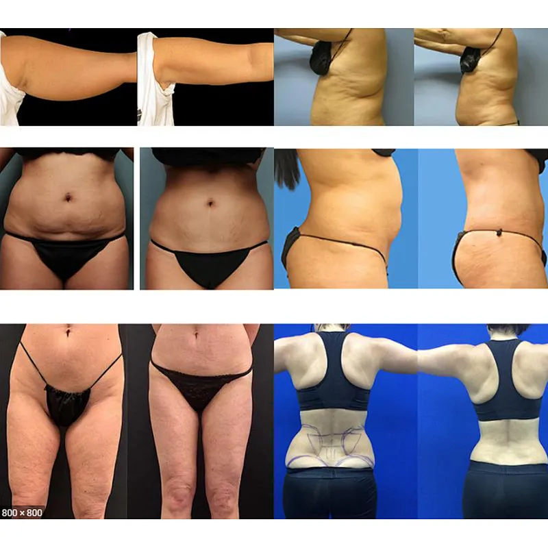 Medical Surgery Laser Machine 980 1470 Diode Laser 3D 5D 4D Lipo Laser Lipolysis Lipolysis Liposuction Endolaser Surgery