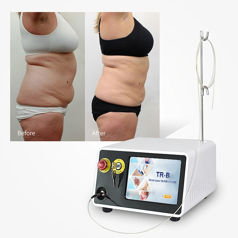 Tazlaser TR-B 980nm 1470nm Vaser Liposuction Machine Endolaser Papada Lipolysis and Facial Lifting