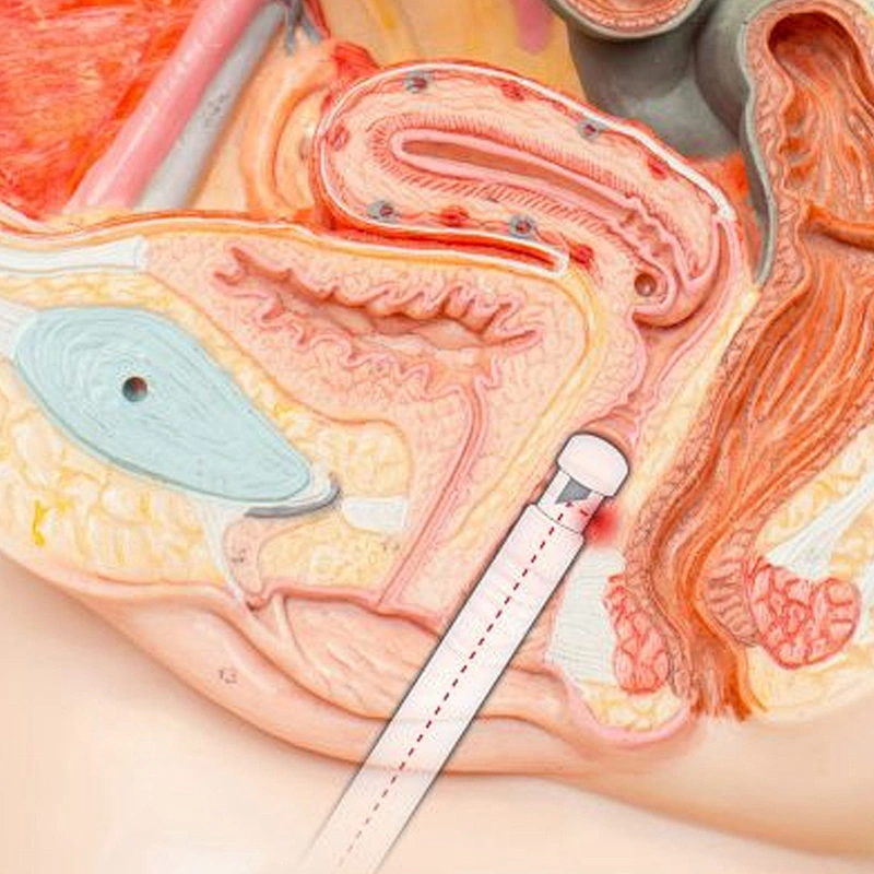 Newly Developed Vaginal Tightening Fiber Probe Laser for Vaginal Relaxation