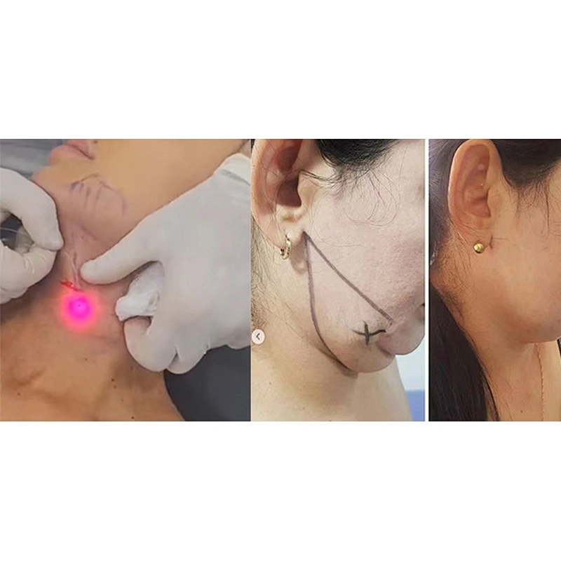 980nm Fat Removal Lipomas  Face Lifting Liposuction Endolaser