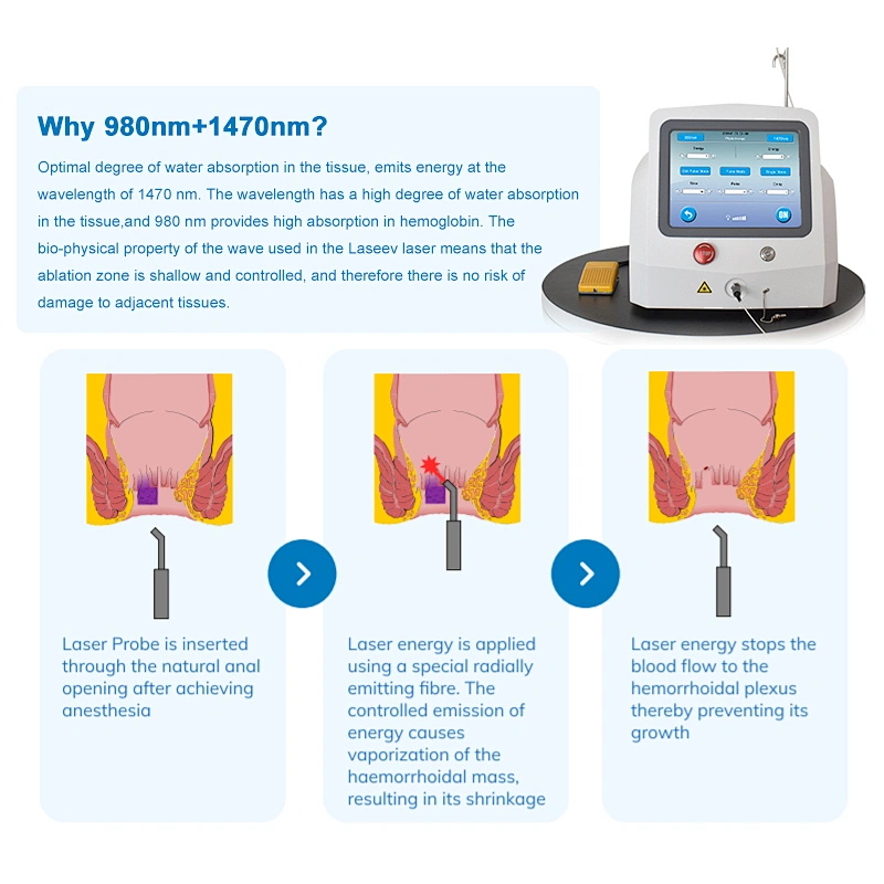 Dual Wave 980nm 1470nm Diode Laser Portable Equipment for Hemorrhoid Remove Proctological Trentment Piles