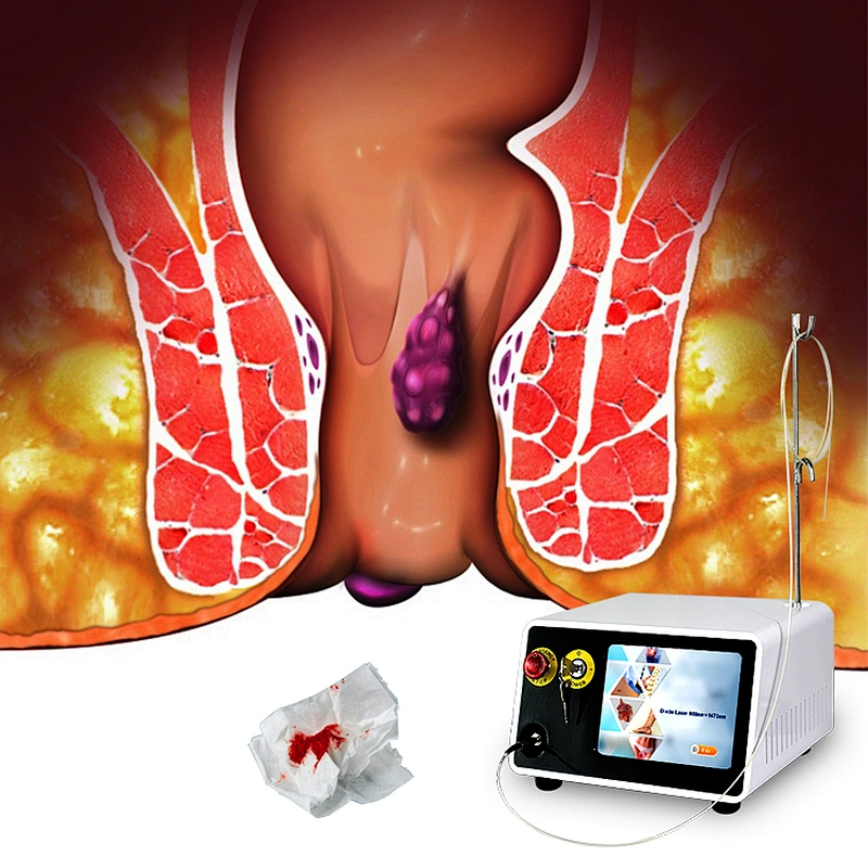 TRIANGEL Ablation Laser Device Diode Laser/1470nm Surgical Laser for Pilonidal Sinus/hemorrhoids Treatment
