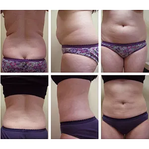 980nm Laser Gynecomastia Lipolysis  Facelift Plasticsurgery