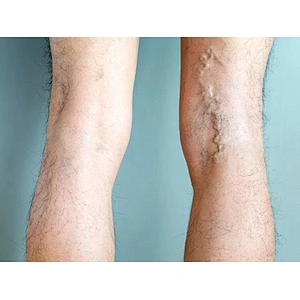 Factory Supply Best Quality EVLT Laser Varicose Veins Removal High Power Varicosity Treatment for Sale