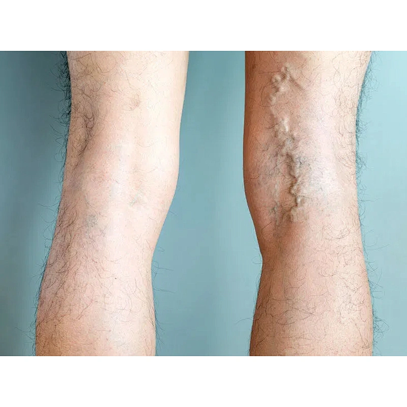 Factory Supply Best Quality EVLT Laser Varicose Veins Removal High Power Varicosity Treatment for Sale