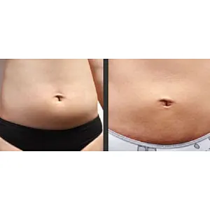 New Arrival Italy 1470nm 15W 30W Endolaser Liposuction Lipolysis Machine