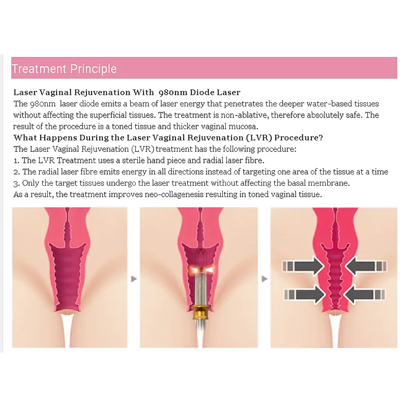 Non Surgical Portable Vaginal Rejuvenation Diode  980nm Cosmetic Gynecology Laser Device Vaginal Tightening
