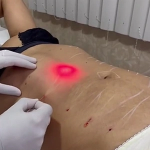 Best Price 1470nm  Fiber Lift Laser Lipolysis  No Pain No Bleeding Face Lifting Skin Tightening