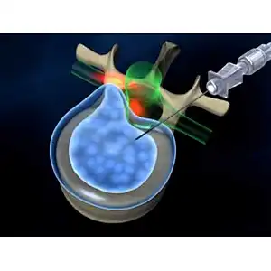 Disk Herniation Laser Treatment Disc Decompression Spine Surgery PLDD Surgical Diode Laser 980nm