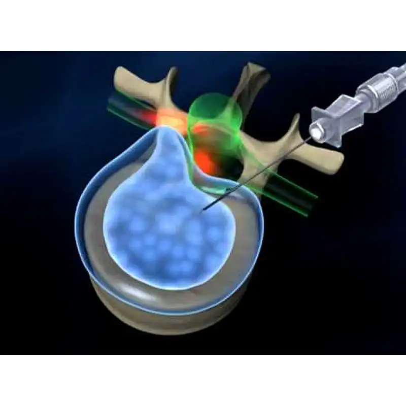 Disk Herniation Laser Treatment Disc Decompression Spine Surgery PLDD Surgical Diode Laser 980nm