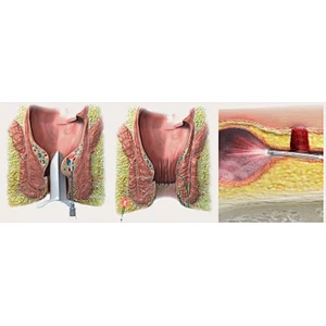 Dual Wave Diode Laser Portable Equipment 980 1470 Nm For Hemorrhoid Remove Proctological Trentment Piles