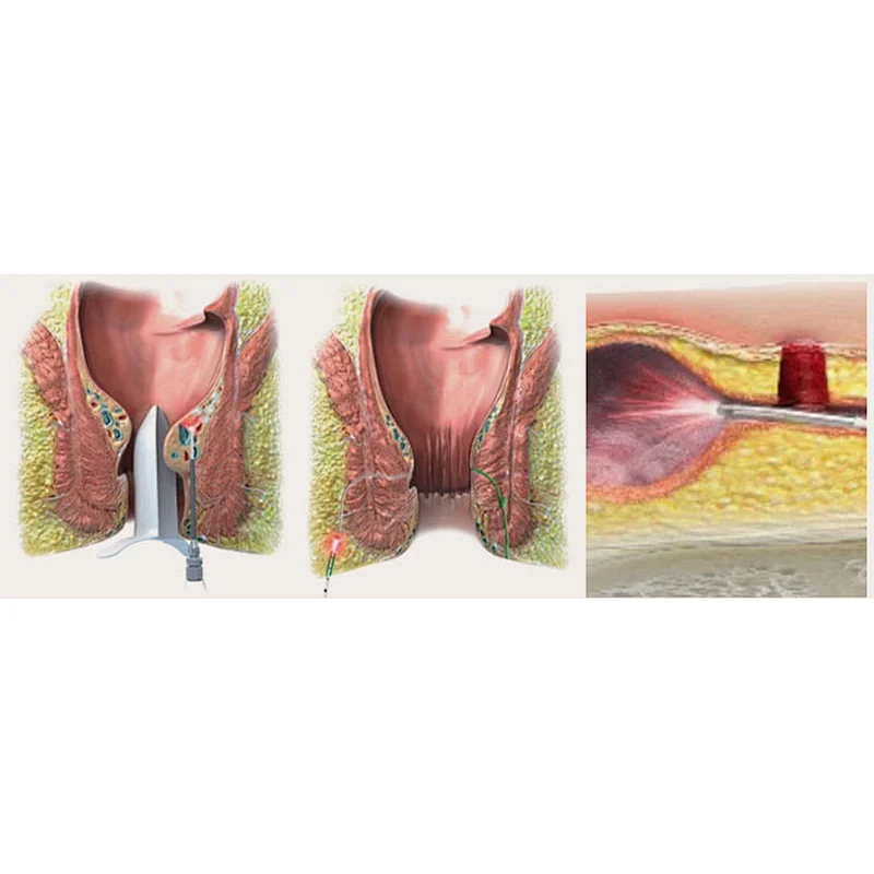 Dual Wave Diode Laser Portable Equipment 980 1470 Nm For Hemorrhoid Remove Proctological Trentment Piles