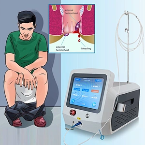 Dual Wave 980nm 1470nm Diode Laser Portable Equipment for Hemorrhoid Remove Proctological Trentment Piles