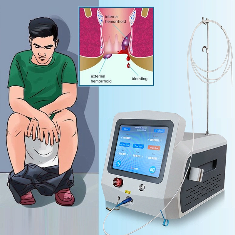 Dual Wave 980nm 1470nm Diode Laser Portable Equipment for Hemorrhoid Remove Proctological Trentment Piles