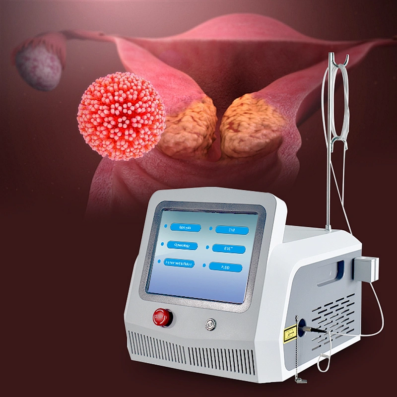 Gynecological 980 1470nm Minimally Invasive Laser Therapy Ovarian Endometriosis Adhesiolyses
