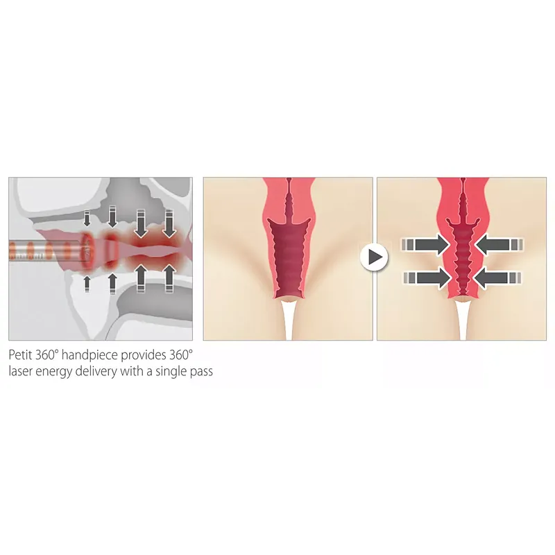 Non Surgical Portable Vaginal Rejuvenation Diode  980nm Cosmetic Gynecology Laser Device Vaginal Tightening