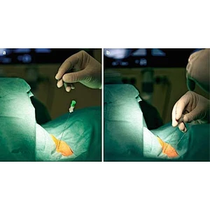 Disk Herniation Laser Treatment Disc Decompression Spine Surgery PLDD Surgical Diode Laser 980nm