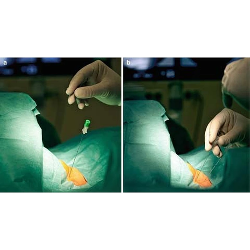 Disk Herniation Laser Treatment Disc Decompression Spine Surgery PLDD Surgical Diode Laser 980nm