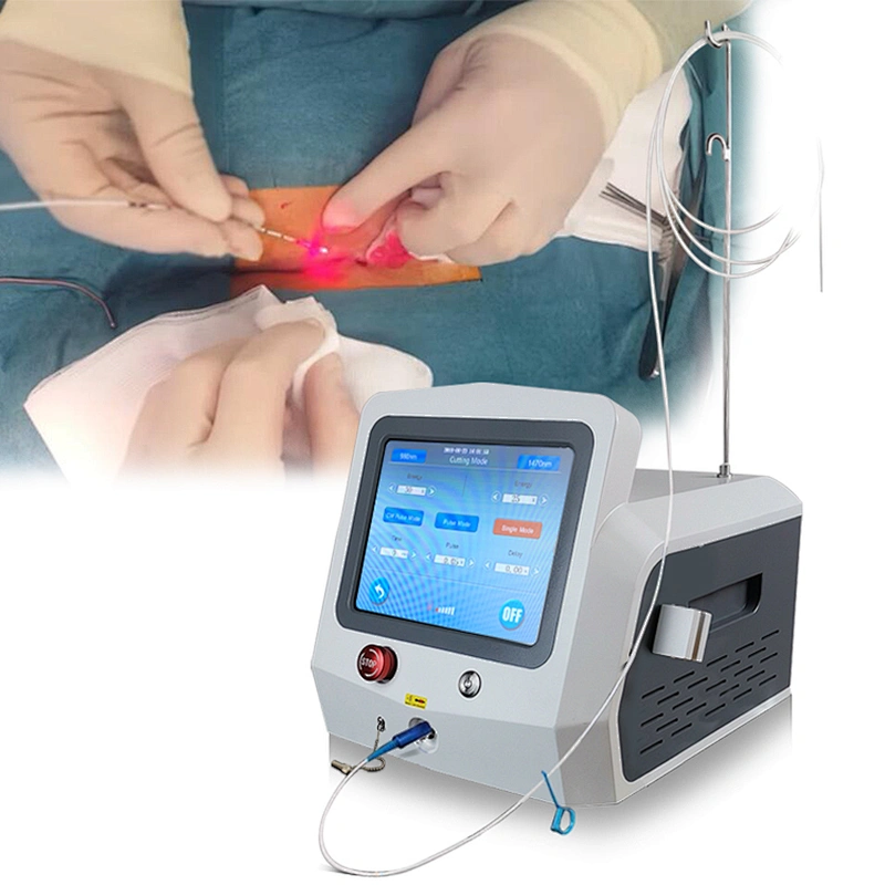 Factory Price Hot Sale Proctology Laser Surgery Machine Diode Laser 980nm1470nm Treatment Hemorrhoids(piles)