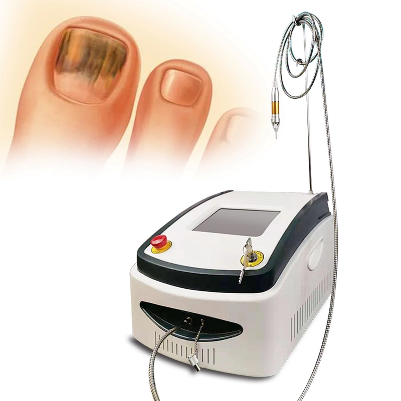 980nm Nail Fungus Diode Laser Machine Treatment Onychomycosis Nail Fungus Podiatry Plantar Warts Onychomycosis