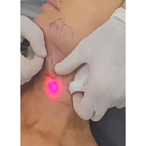 980nm Fat Removal Lipomas  Face Lifting Liposuction Endolaser