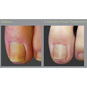 Laser Podiatry Onychomycosis Nail Fungus Treatment Diode Laser 1064 980 nm Fungal Nail Laser Machine