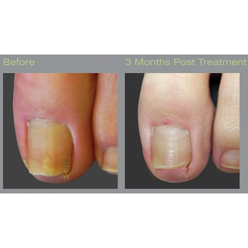 Laser Podiatry Onychomycosis Nail Fungus Treatment Diode Laser 1064 980 nm Fungal Nail Laser Machine