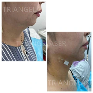 1470nm Machine Liposuction  Laser Plastic Surgery Endolaser Machine