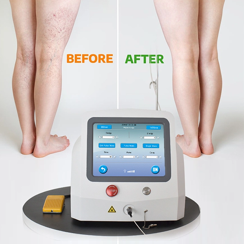 Varicose Veins Laser Treatment Machine Laser De Diodo