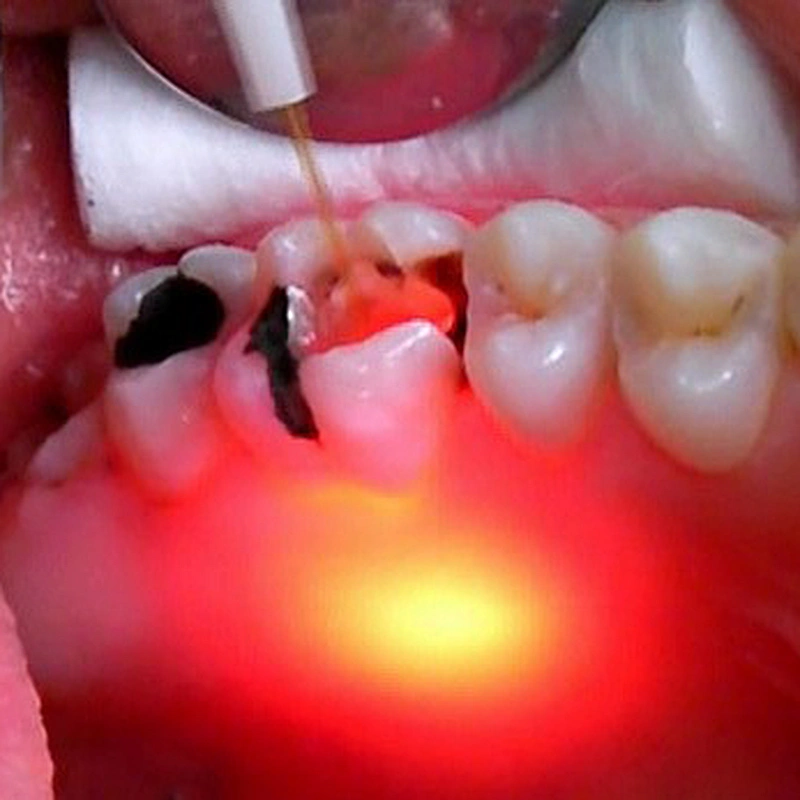 Portable Single Wavelengths 980nm Dentistry Remove Tooth Decay Whitening Laser Treatment Machine