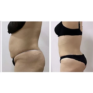 Newest Endolaser 1470nm 980nm Diode Laser Face Lifting Liposuction Machine Liposuct Endo Laser Lift