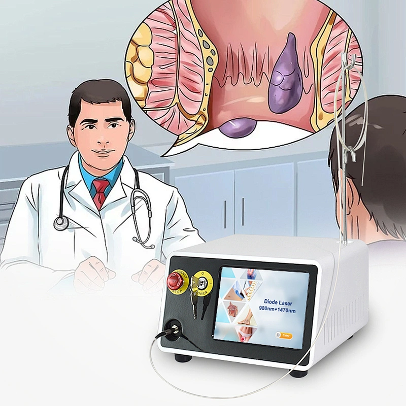 980nm 1470nm Hemorrhoidsurgery Haemorrhoids  Piles Fissure and Fistula Laser Machine
