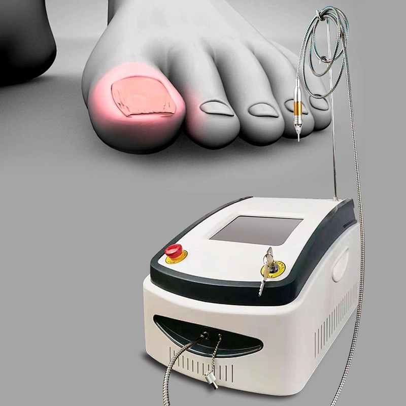 980nm Diode Laser Onychomycosis Nail Fungus Treatment Laser Onychomycosis Removal  Device