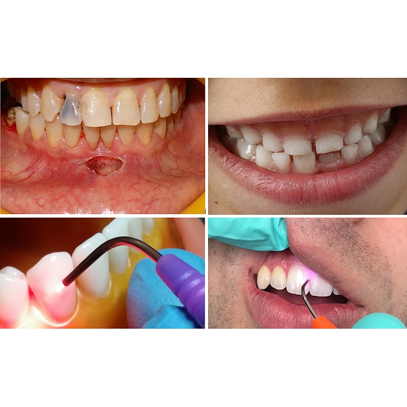 2024 Newest Big Power 980nm Diode Dental Laser Therapy Teeth Whitening Device
