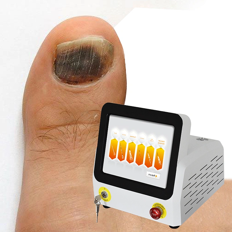 Class IV 980nm Fungus Nail Removal Laser Machine Diode Laser Treatment Podiatry Onychomycosis