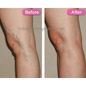 980nm1470nm Diode Laser Physical Therapy Body Pain Relief Machine EVLT Therapy Treatment Machine