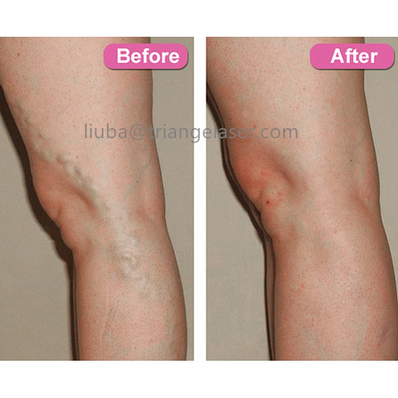 980nm1470nm Diode Laser Physical Therapy Body Pain Relief Machine EVLT Therapy Treatment Machine