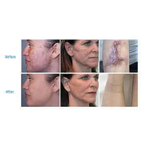 2023 Newest 980nm 1470nm Diode Laser Lipolysis Liposuction Endolaser Machine