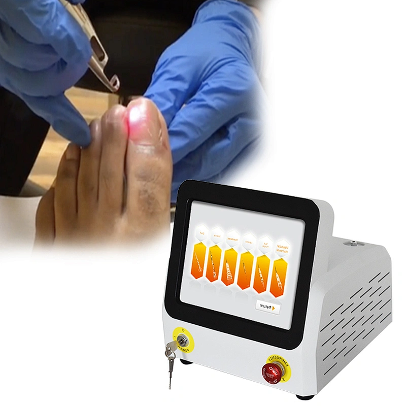 Class IV 980nm Fungus Nail Removal Laser Machine Diode Laser Treatment Podiatry Onychomycosis
