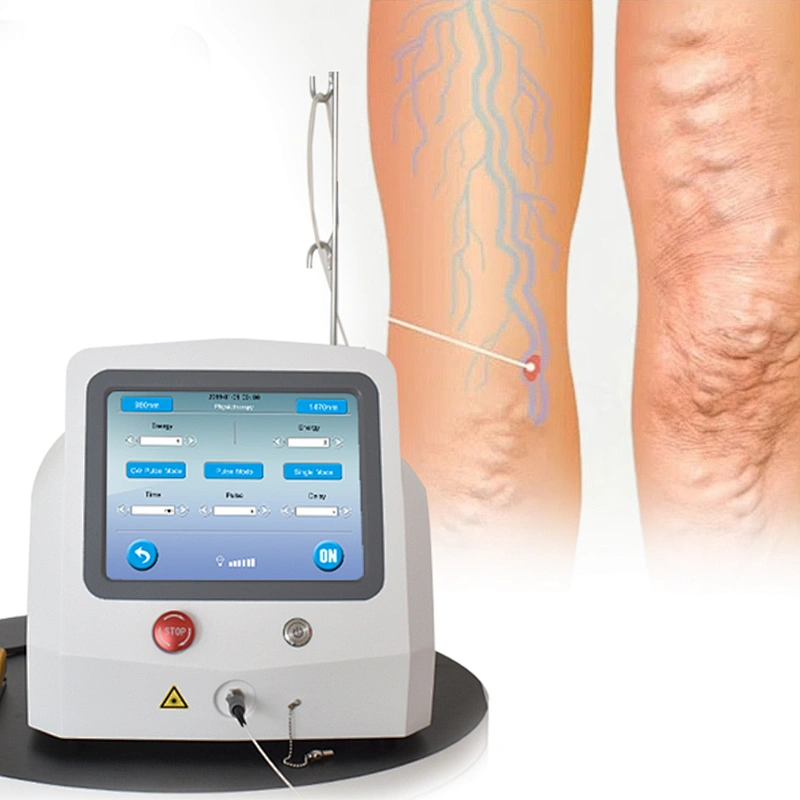 Minimally Invasive EVLT  Varicose Veins Laser 1470 nm  Ablation Therapy  Endovenous EndoLaser Vein Surgery Laser 1470nm